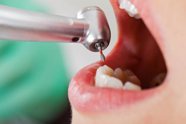 Best Knocked-Out Tooth (Avulsed Tooth) Treatment in Vaiden, MS